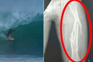 Sebuah Ombak Mematahkan Tulang Paha Ifran Saeppu, Surfer Asal Indonesia